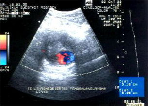 Aneurysma einer Arterie mit Blutgerinnsel